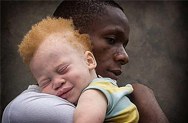 TOP 10 tragičnih činjenica o albino ljudima u Africi