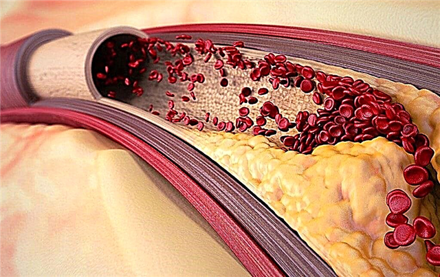 Top 10 easy ways to clean your blood vessels at home