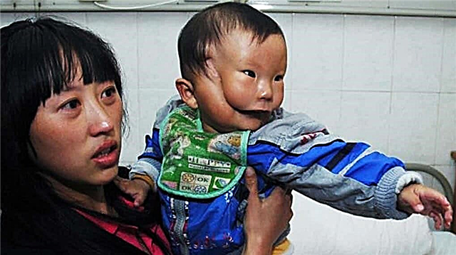 10 people with excess body parts